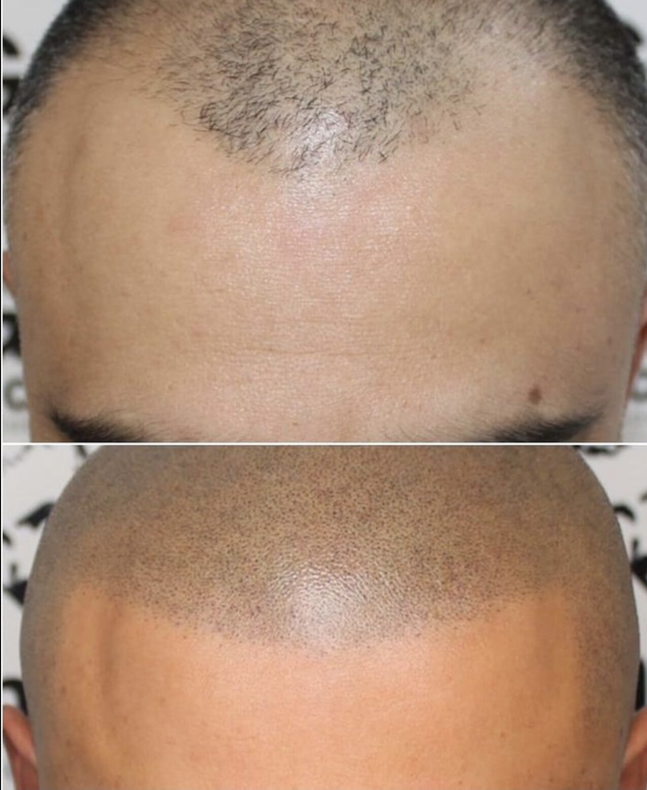 scalp treatment before and after