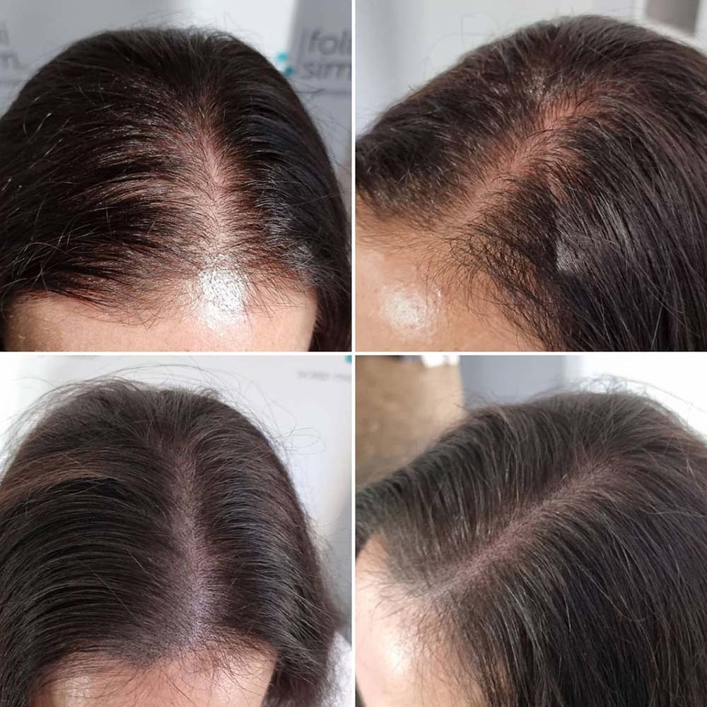 four before and after treatments of hair loss