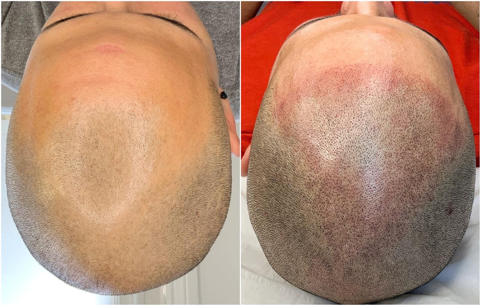 before and after men's hair treatments