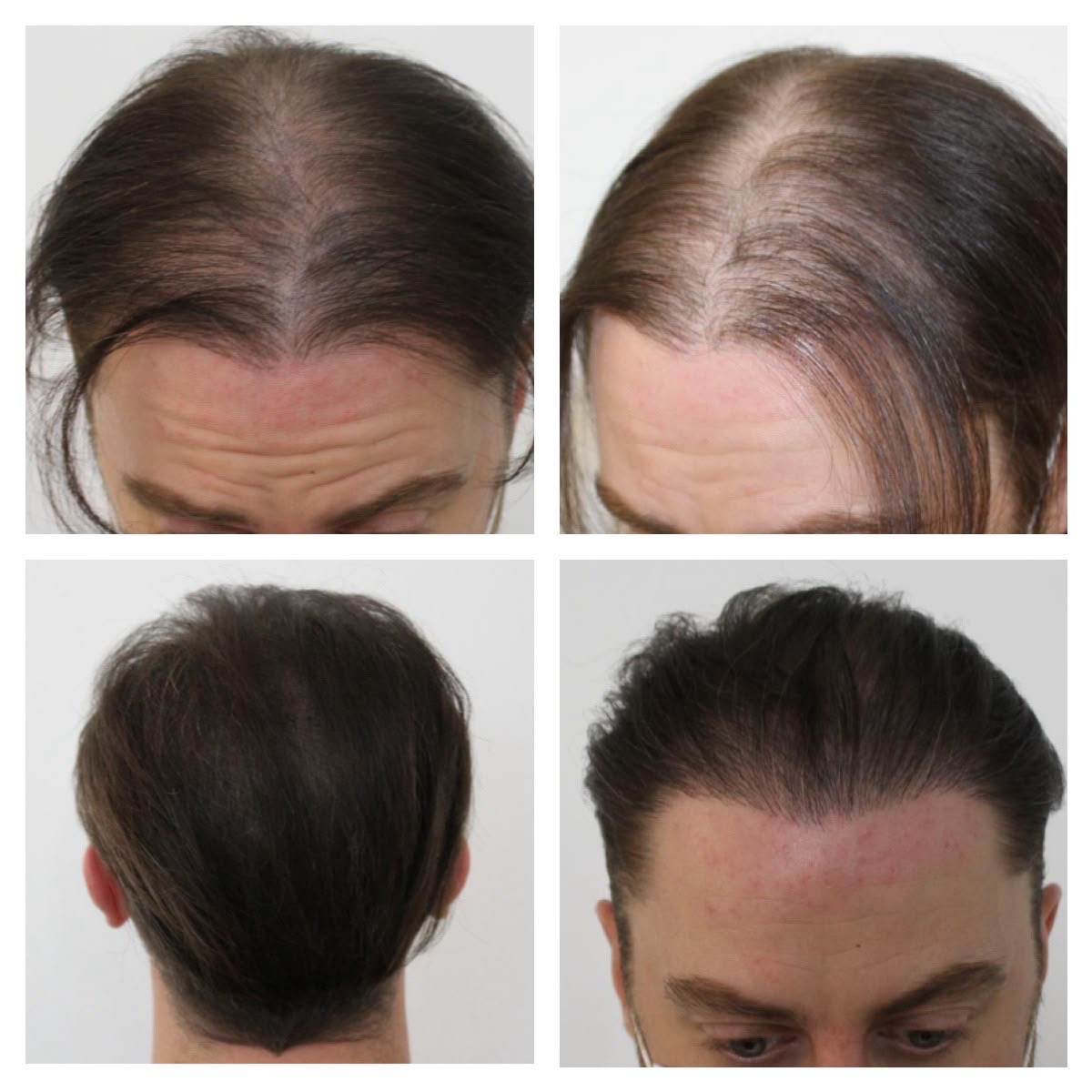 mens before and after treatments