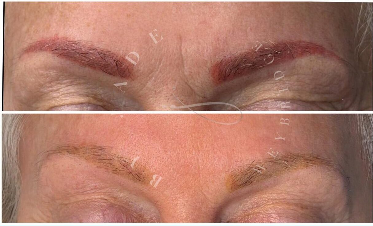 red eyebrows before and after laser