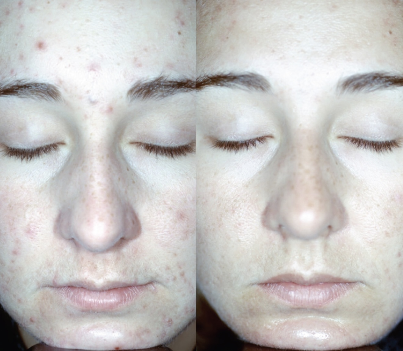Before and after lady teenage spots