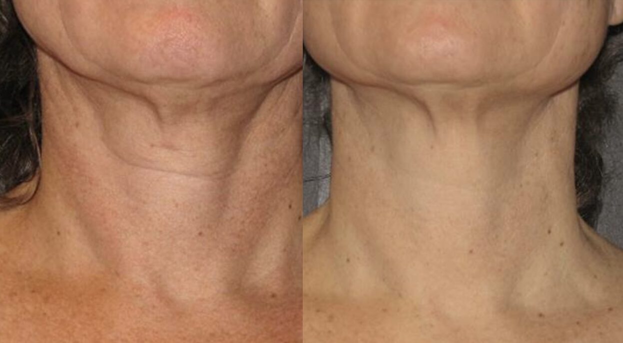 ladies neck before and after