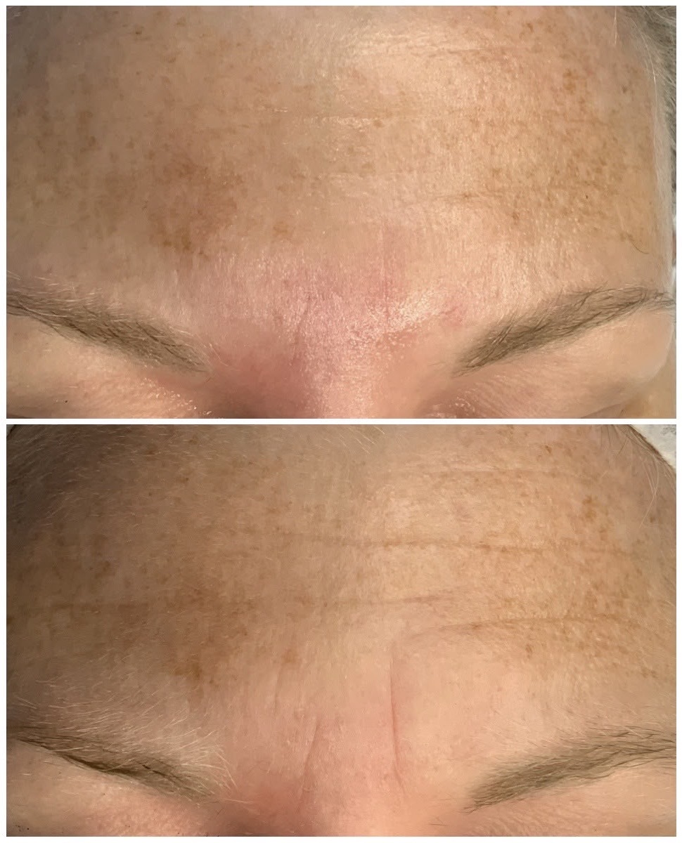 before and after fine lines neostrata
