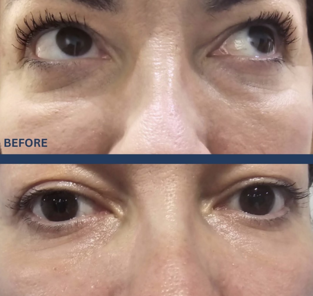 Sunekos before and after eye area