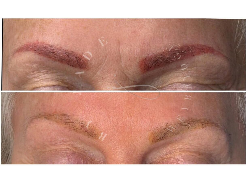 red eyebrows before and after laser