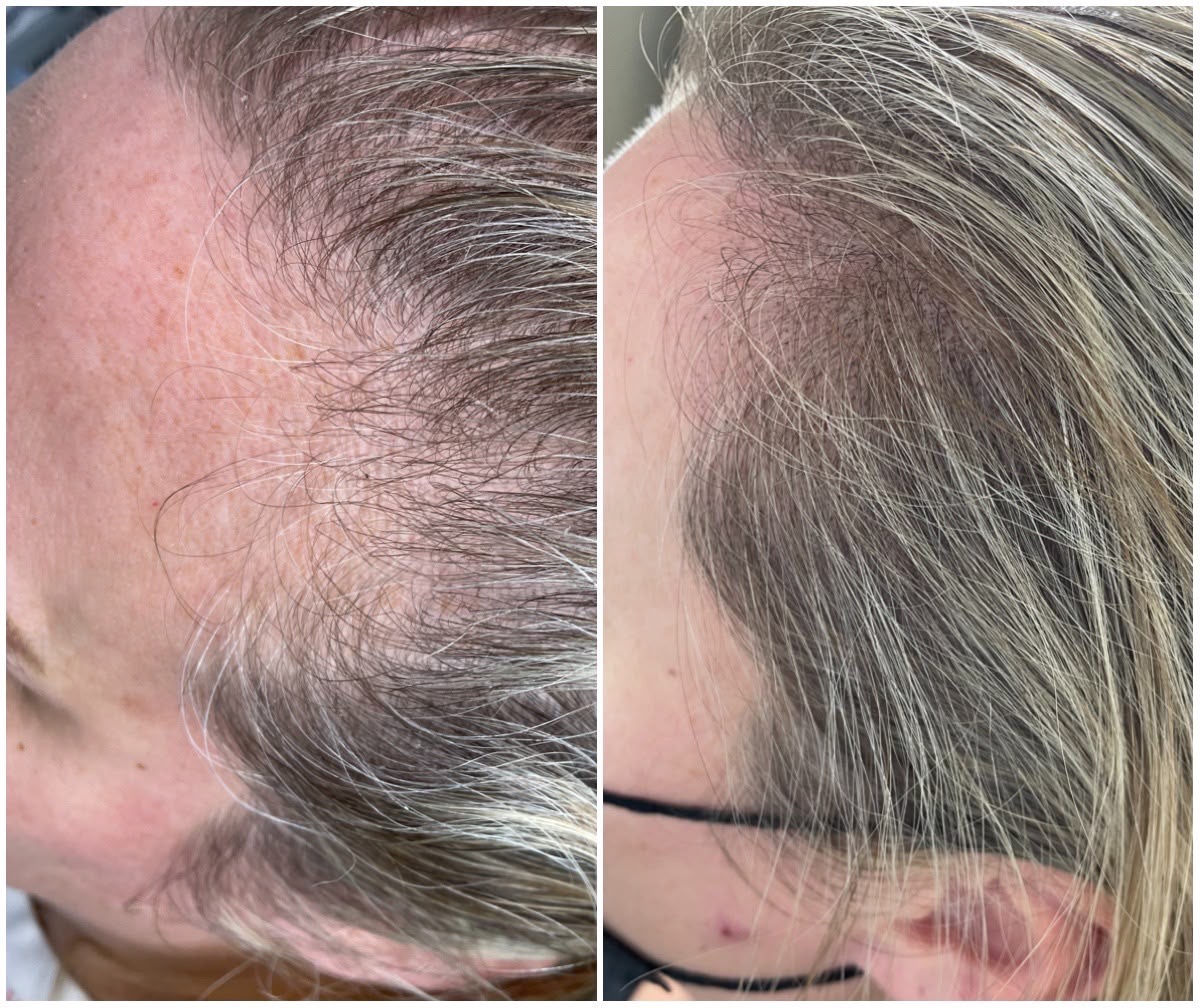 hair treatment grey hair